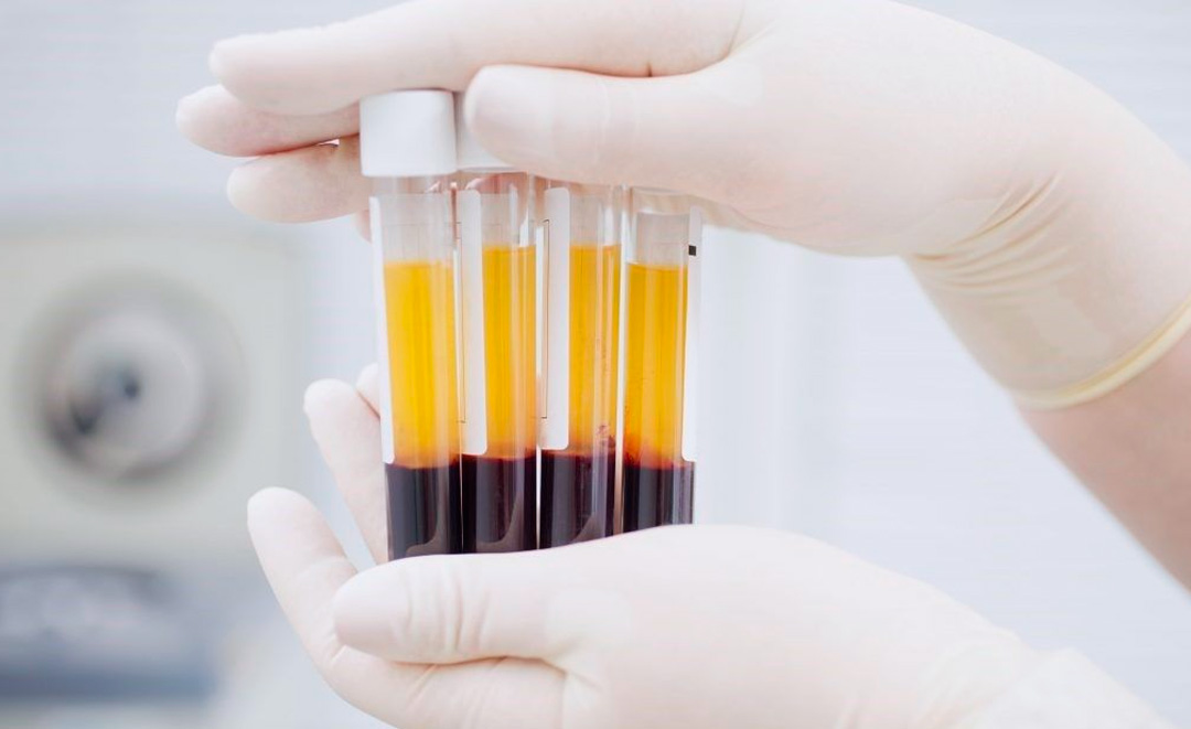 Diferencia entre Células Madre y Plasma Rico en Plaquetas (PRP)